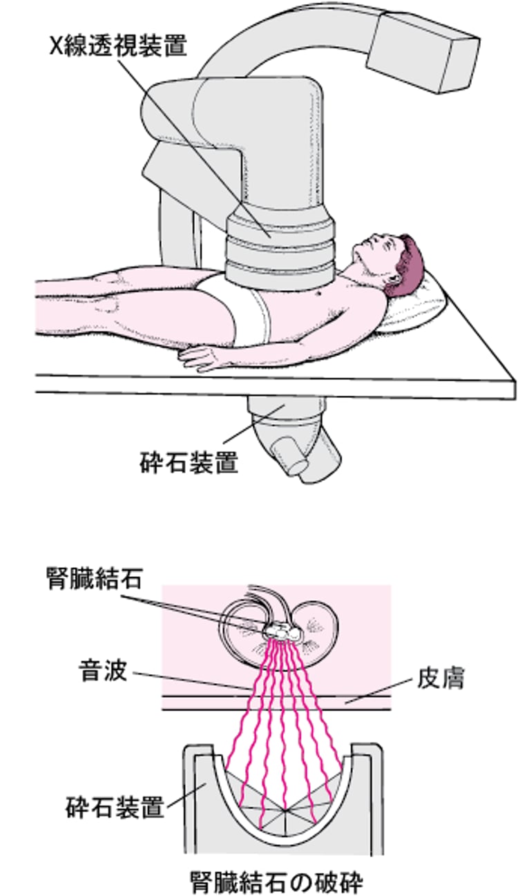 音波による結石の除去