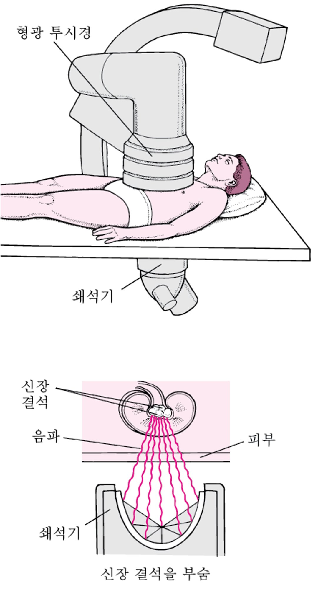 초음파로 결석 제거하기