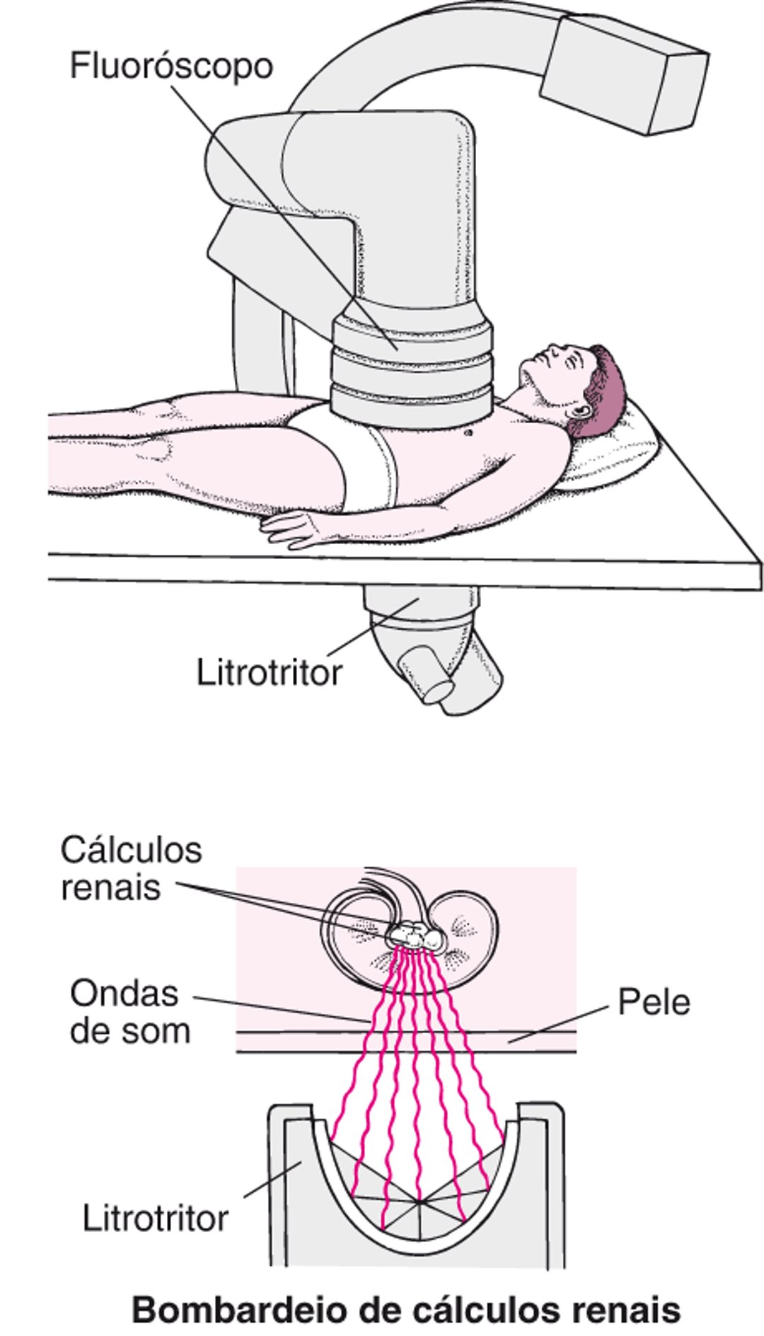 Remoção de um cálculo com ondas sonoras