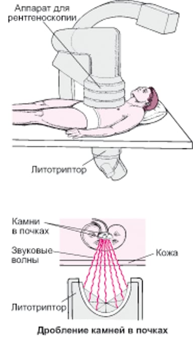 Удаление камня при помощи звуковых волн