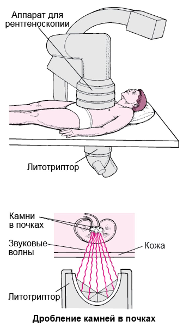 Удаление камня при помощи звуковых волн