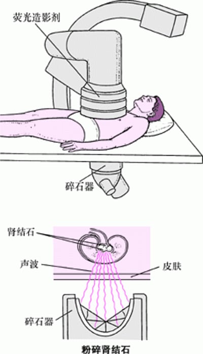 声波取石