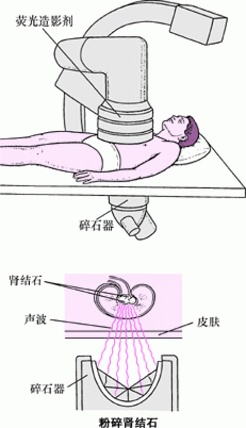 声波取石
