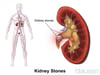 Kidney Stones