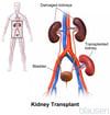 Kidney Transplant