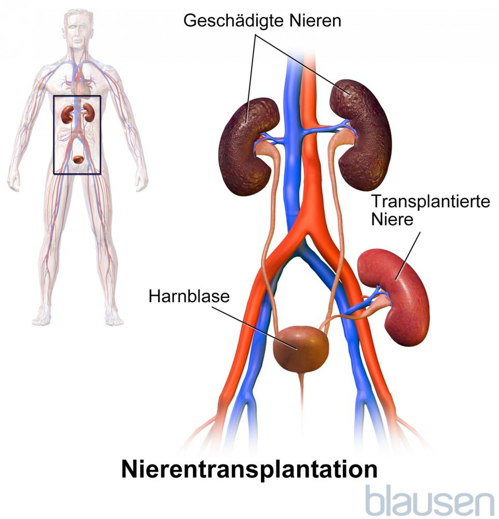 Nierentransplantation