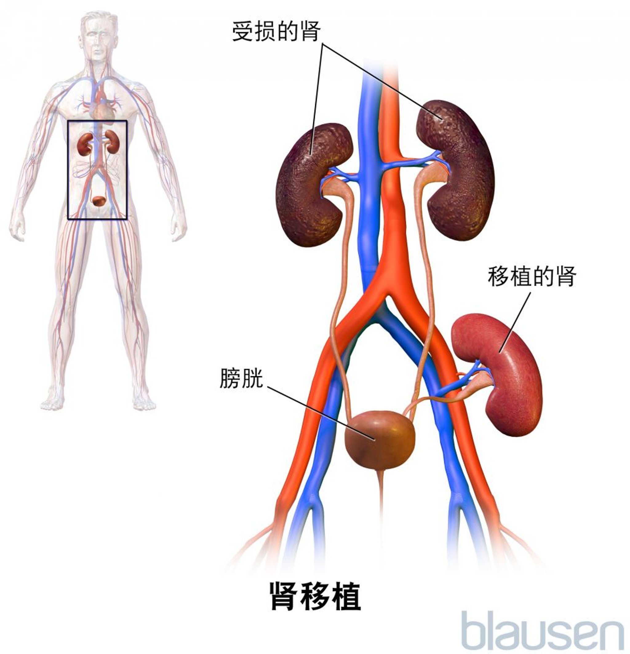 肾移植