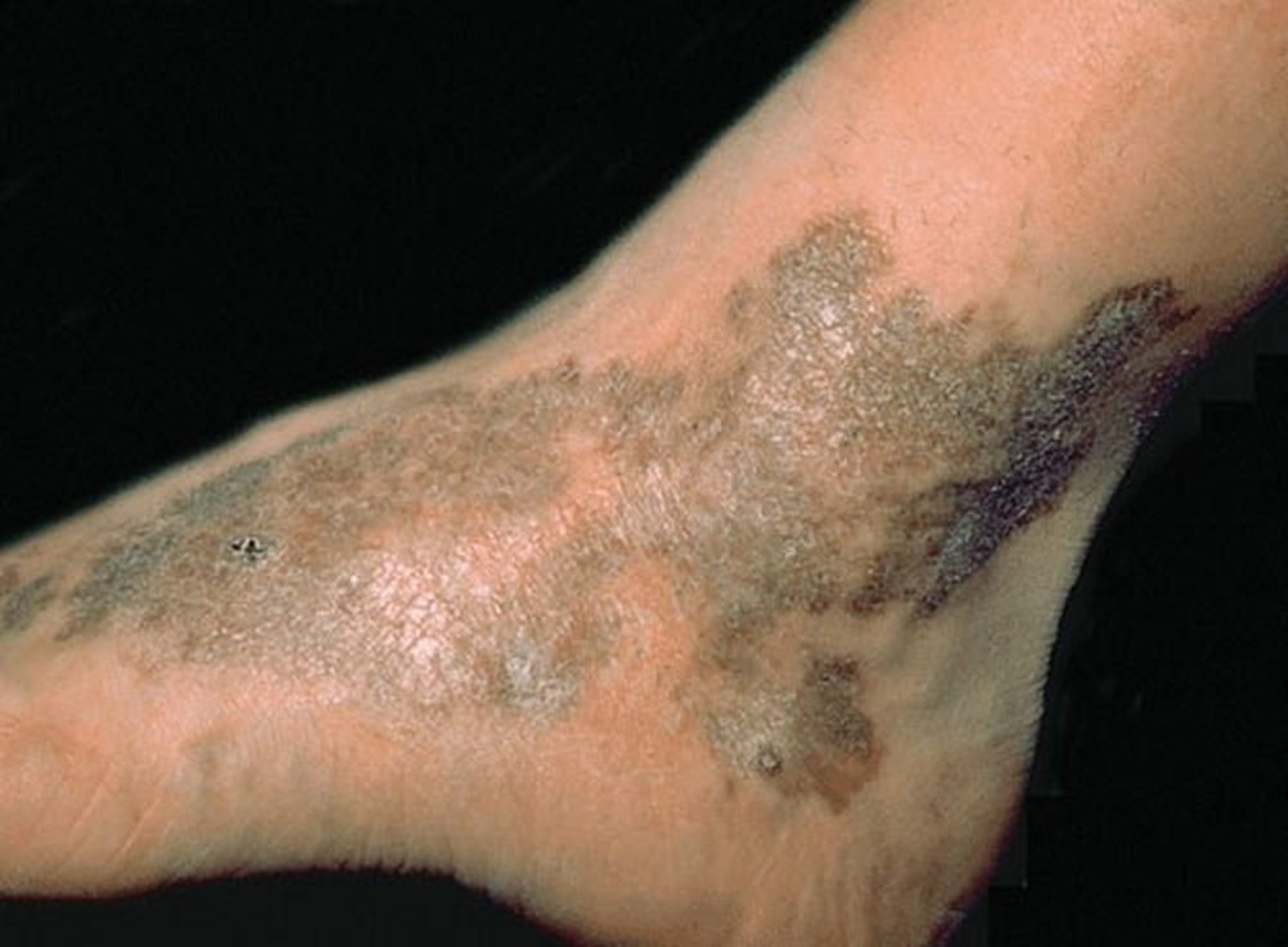 Sarcoma di Kaposi classico