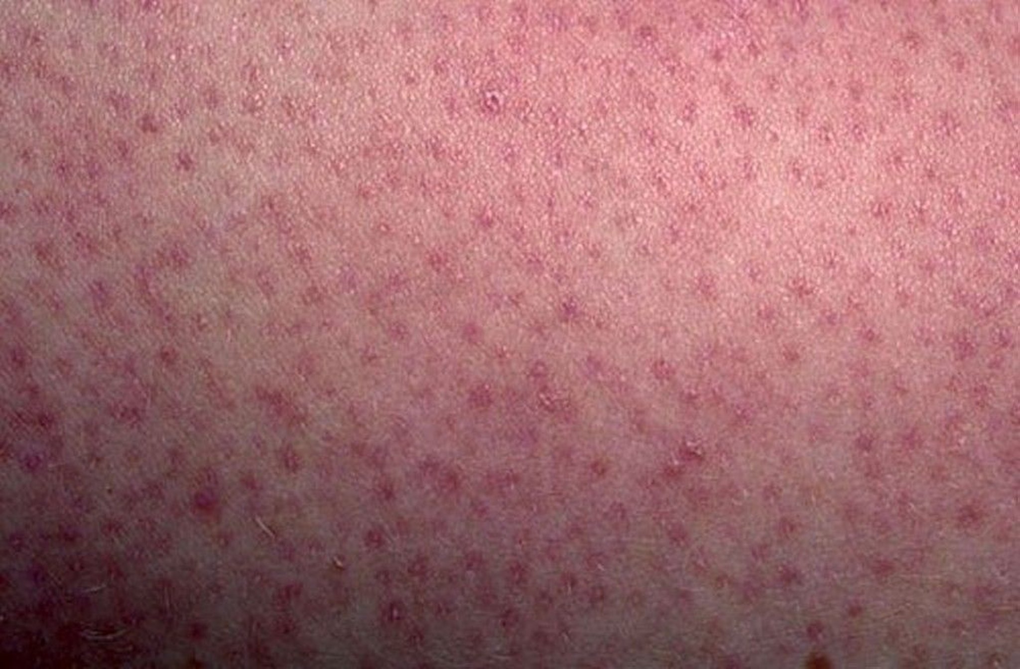 Keratosis Pilaris