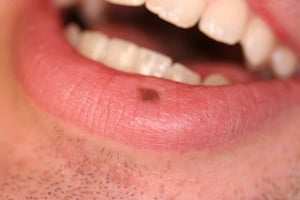 Macule