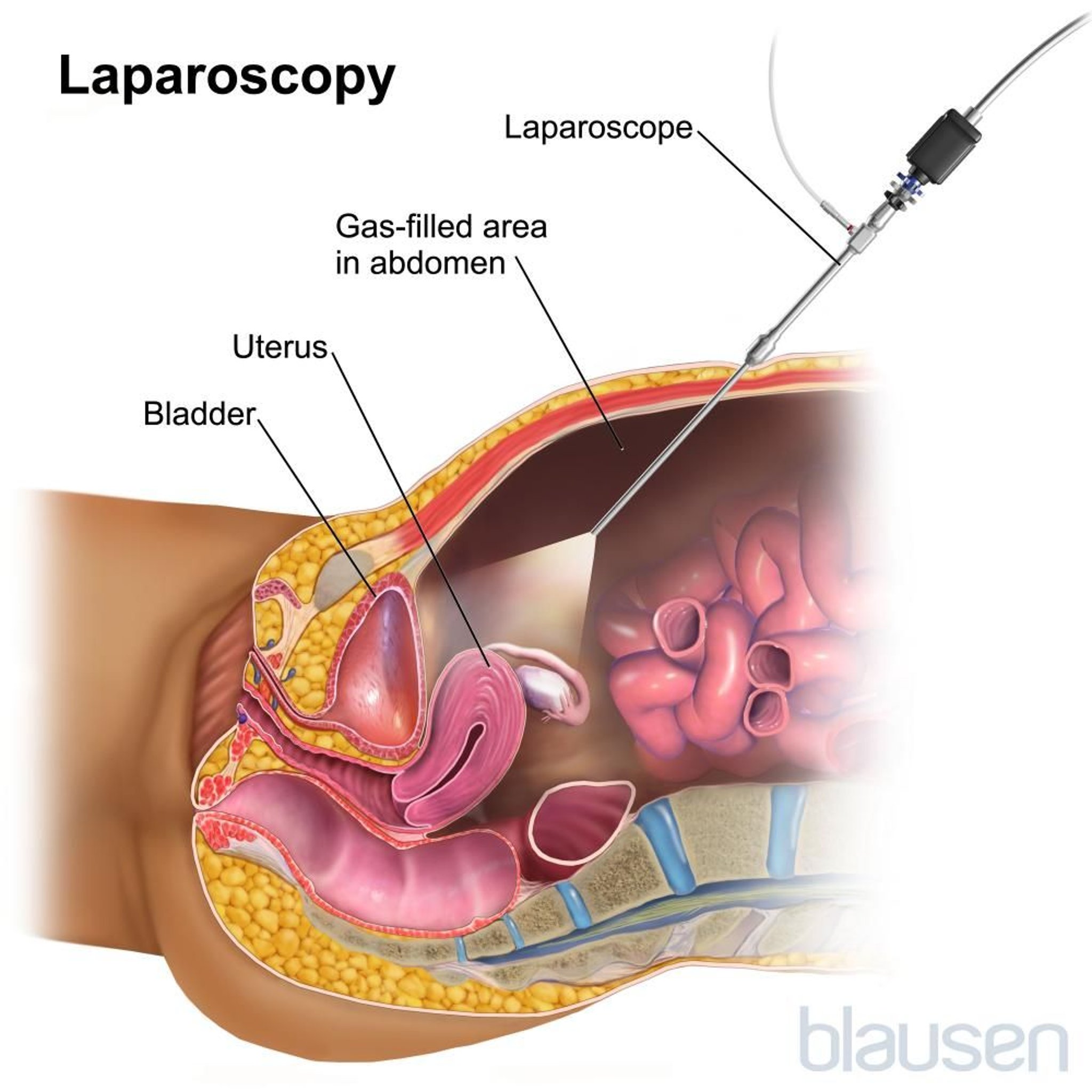 Laparoscopia