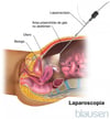 Laparoscopia