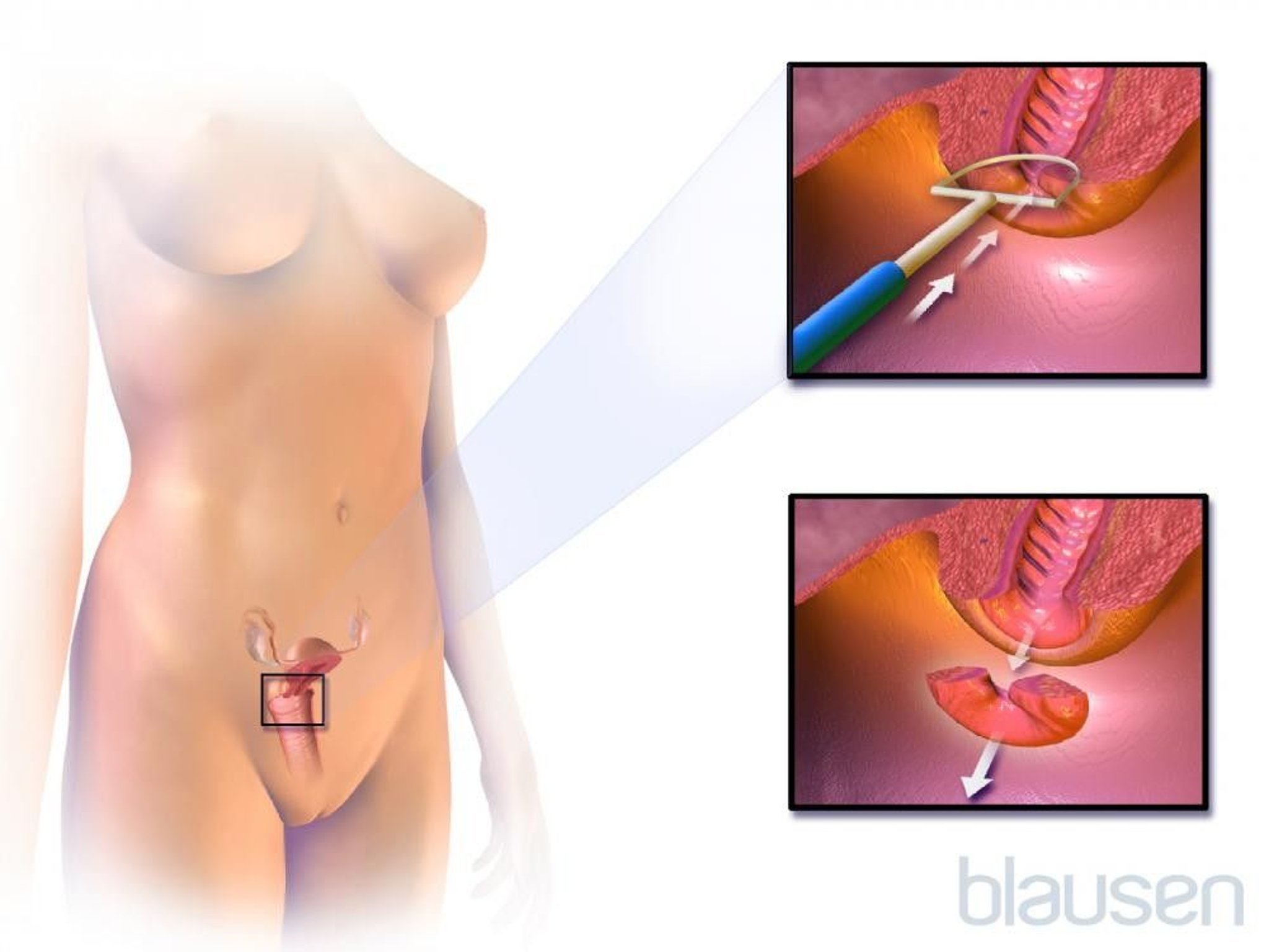 Loop Electrosurgical Excision Procedure (LEEP)