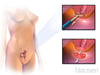 Procédure d'excision électrochirurgicale