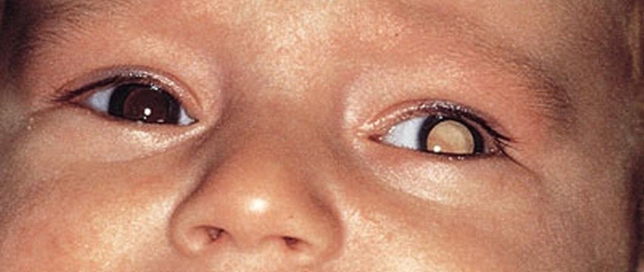 Leukocoria in Infant With Retinoblastoma