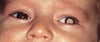 Leucocoria en lactantes con retinoblastoma