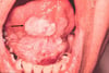 Leukoplakia and Squamous Cell Carcinoma
