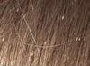 Head Lice