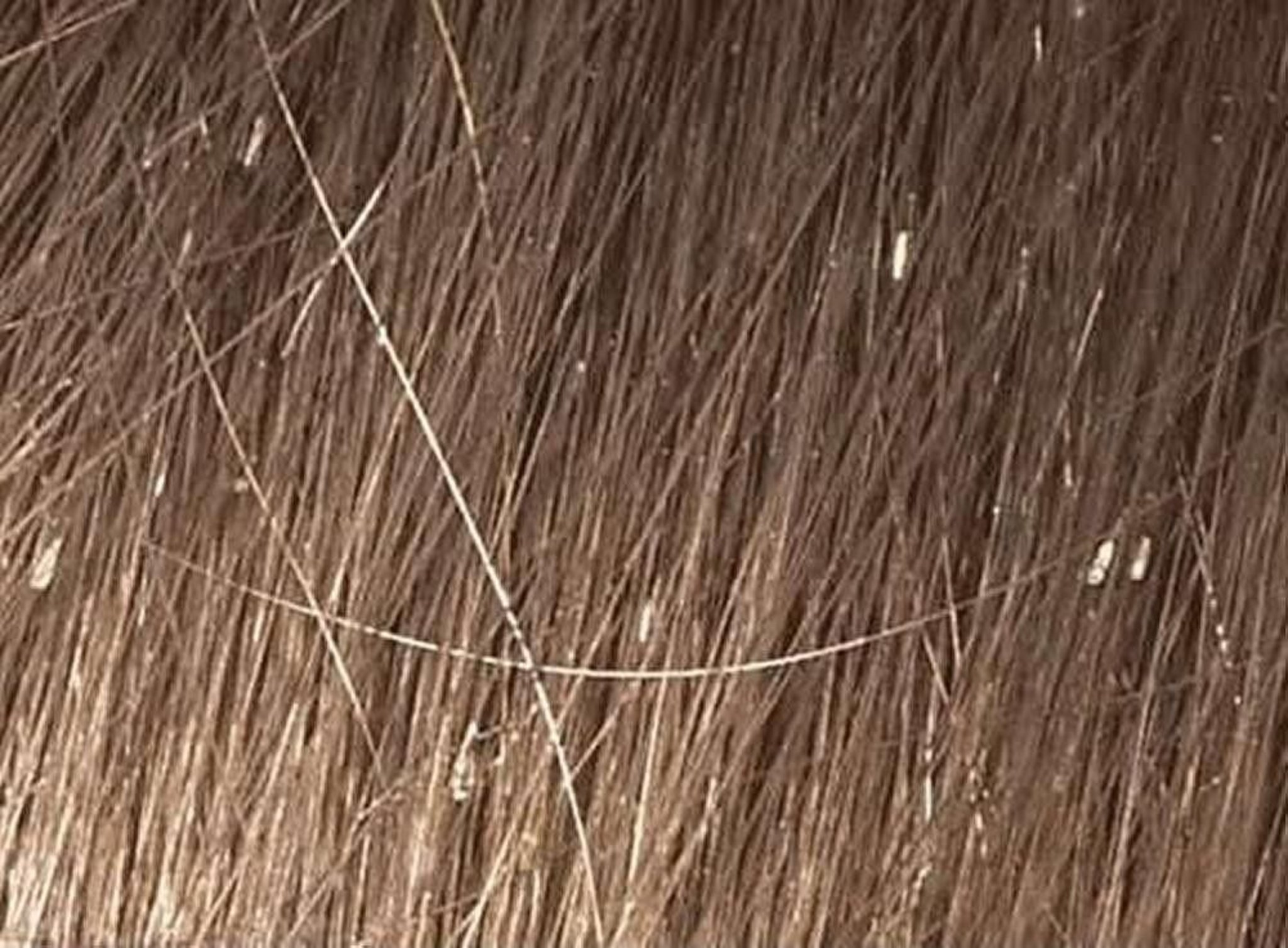Head Lice