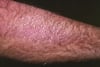 Cutaneous Lichen Amyloidosis (Arm)