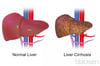 Cirrhosis