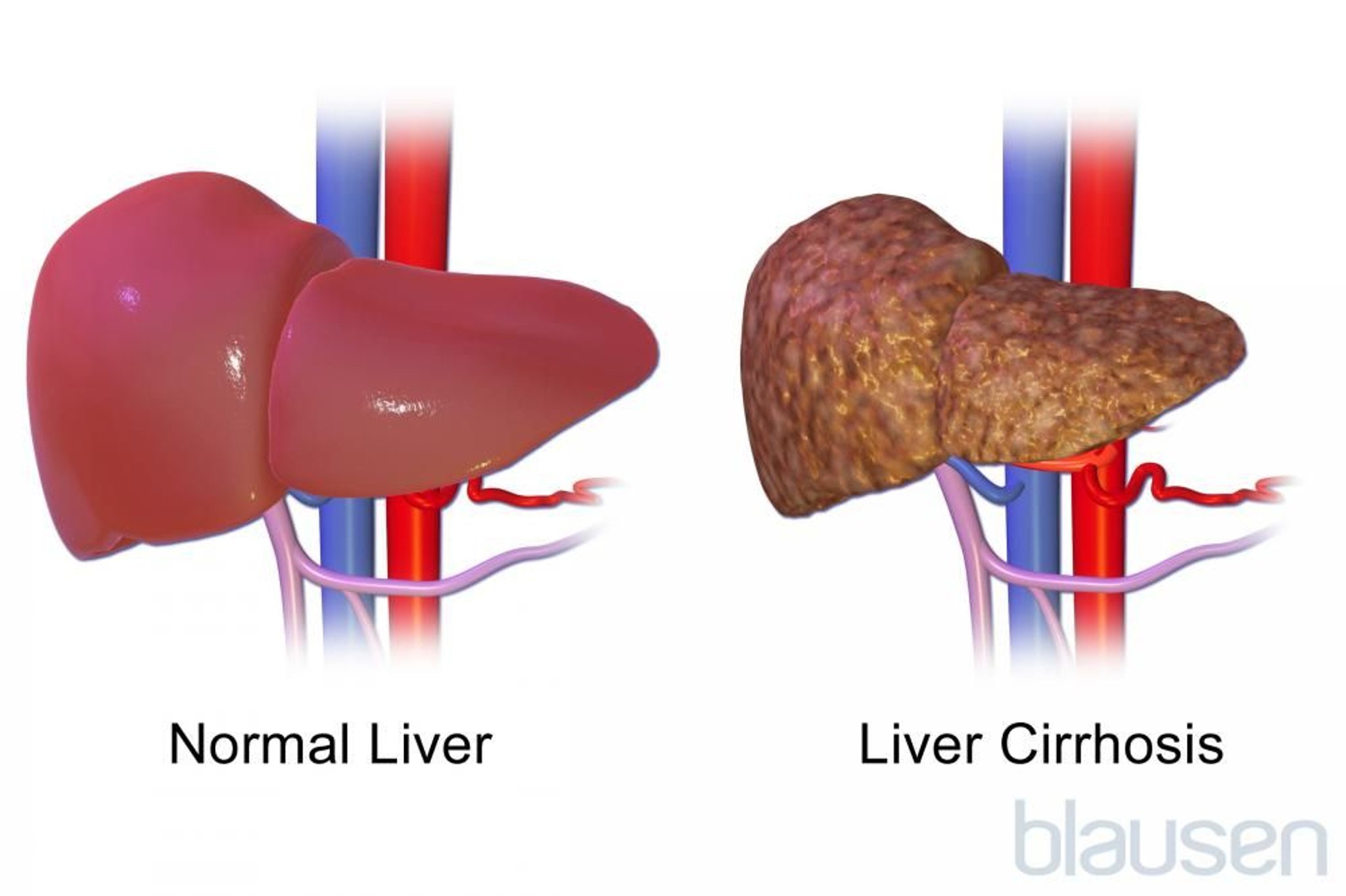 تليّف أو تشمّع الكبد