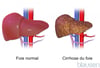 Cirrhose