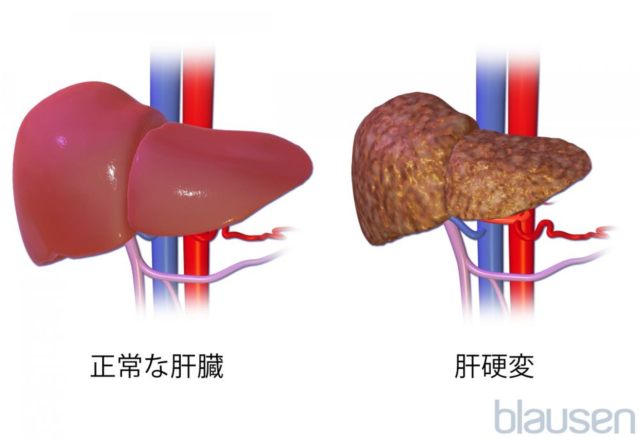 <ruby >肝硬変<rt >かんこうへん</rt></ruby>