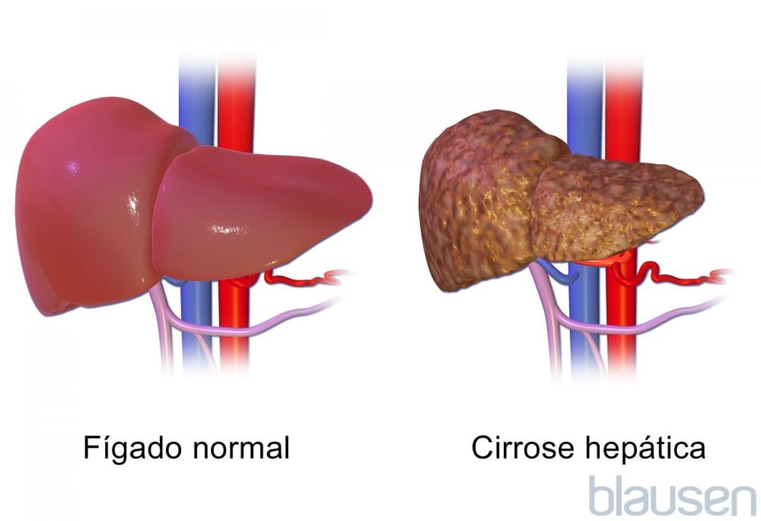 Cirrose hepática - Cirrose hepática - Manual MSD Versão Saúde para a ...