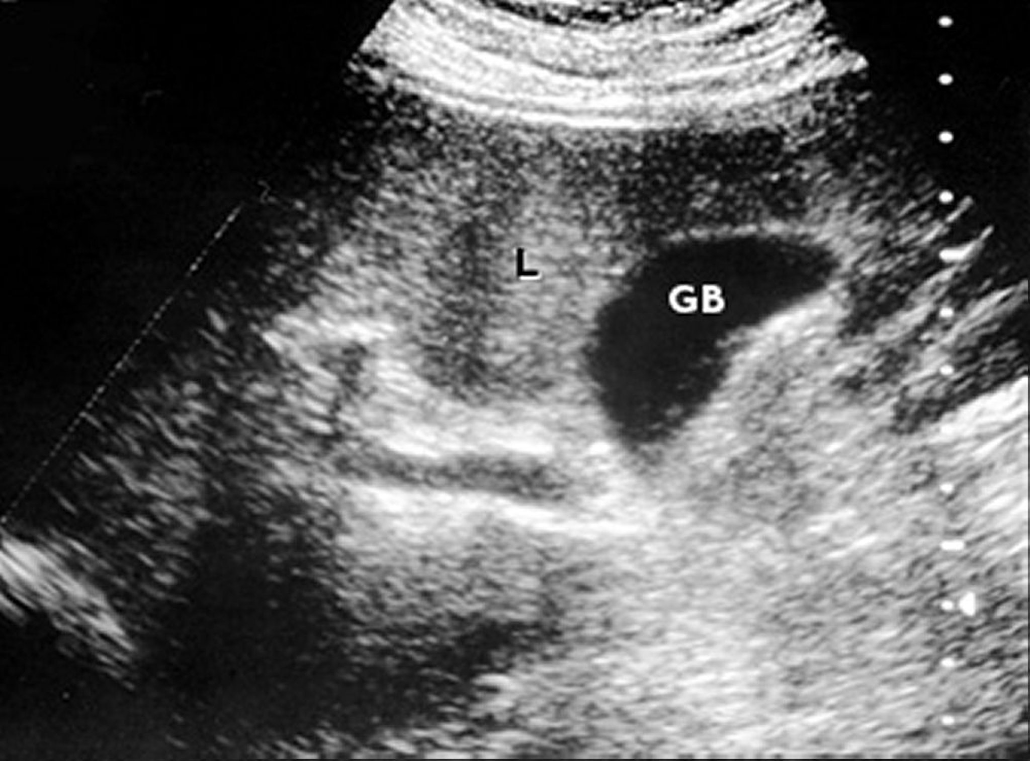 肝臓と胆嚢の超音波検査