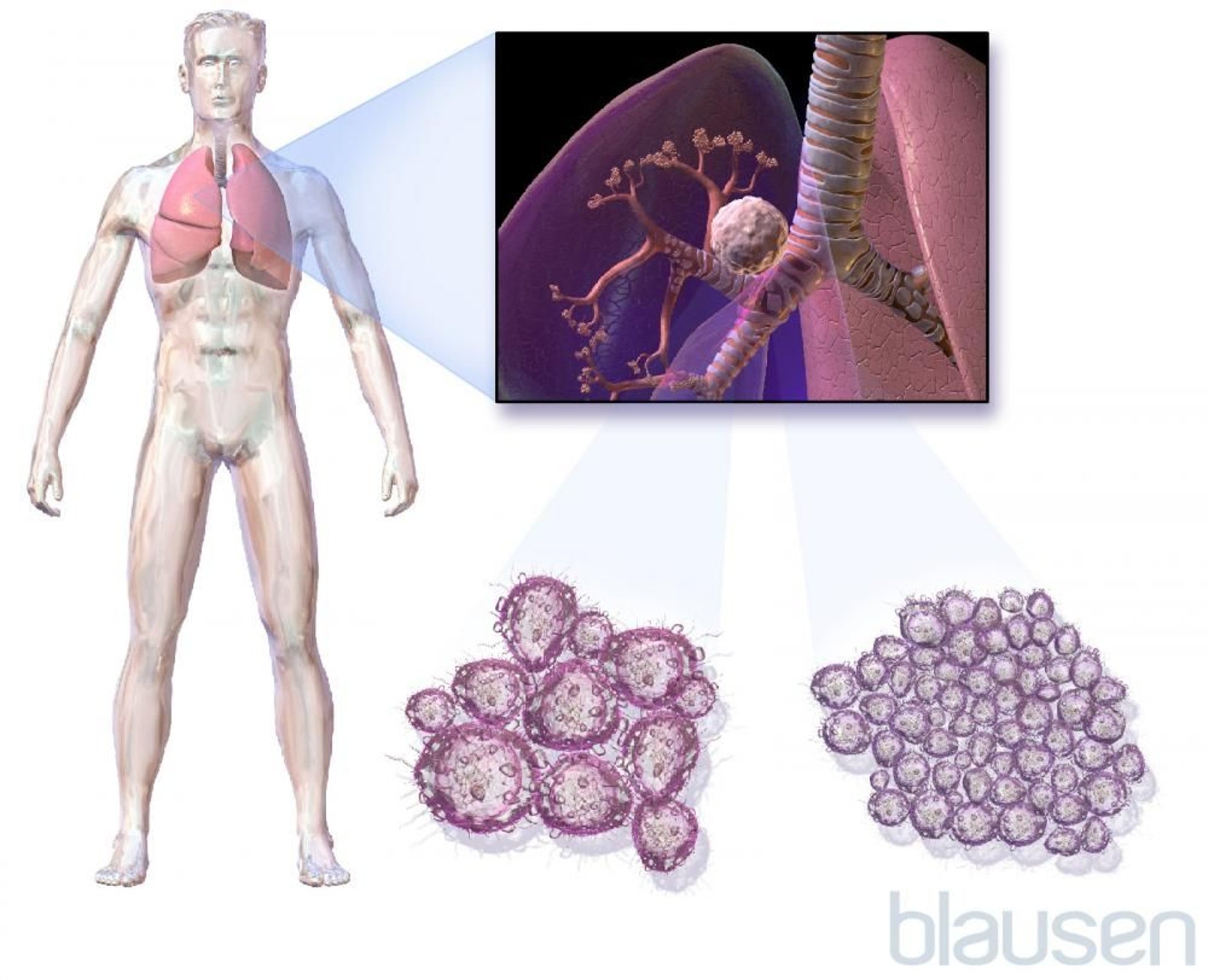 سرطانُ الرئة Lung Cancer