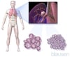 Cáncer de pulmón
