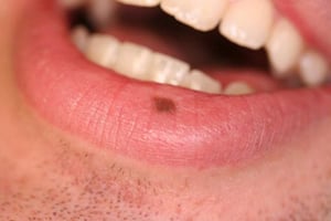 Macule