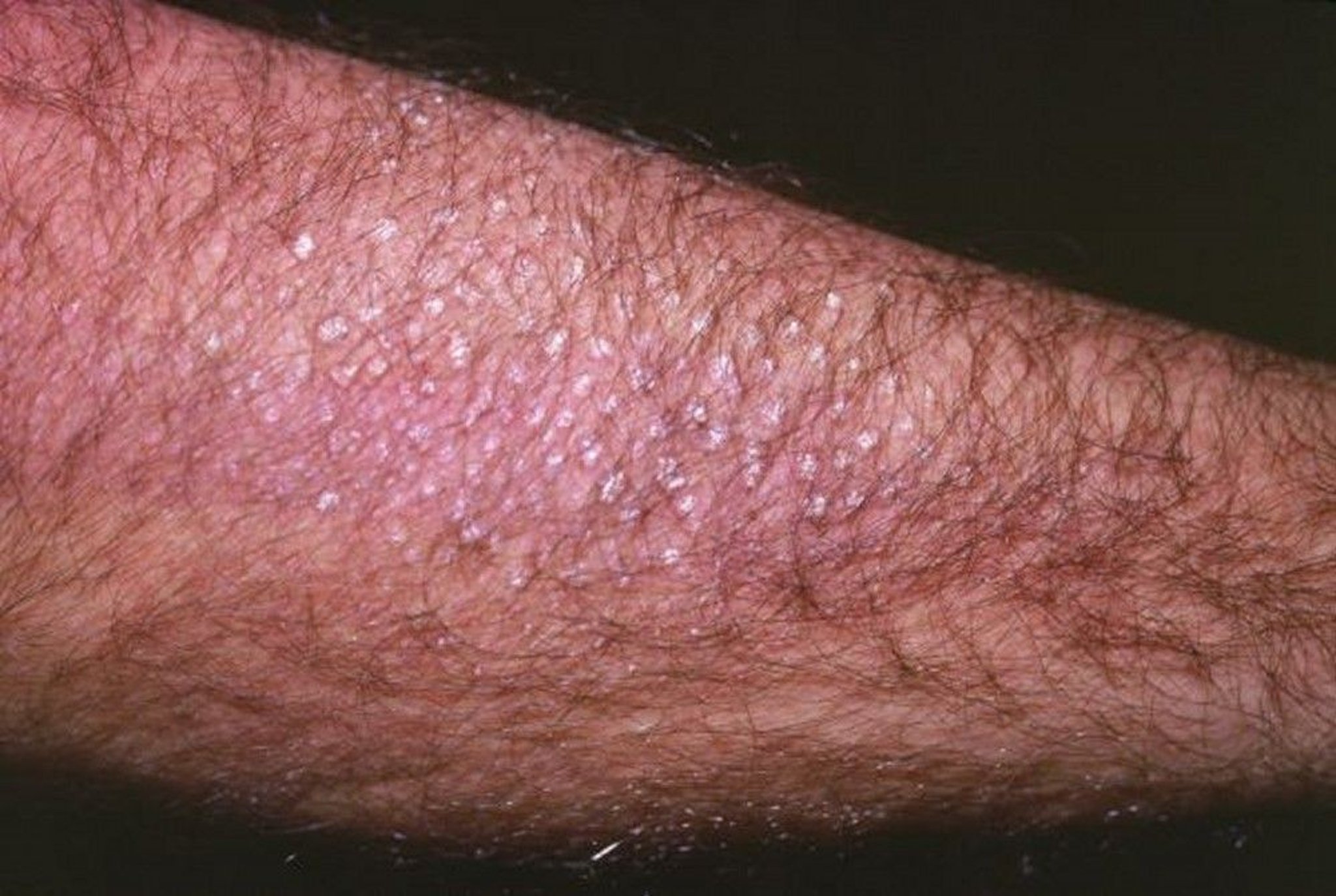 皮膚アミロイド苔癬（腕）