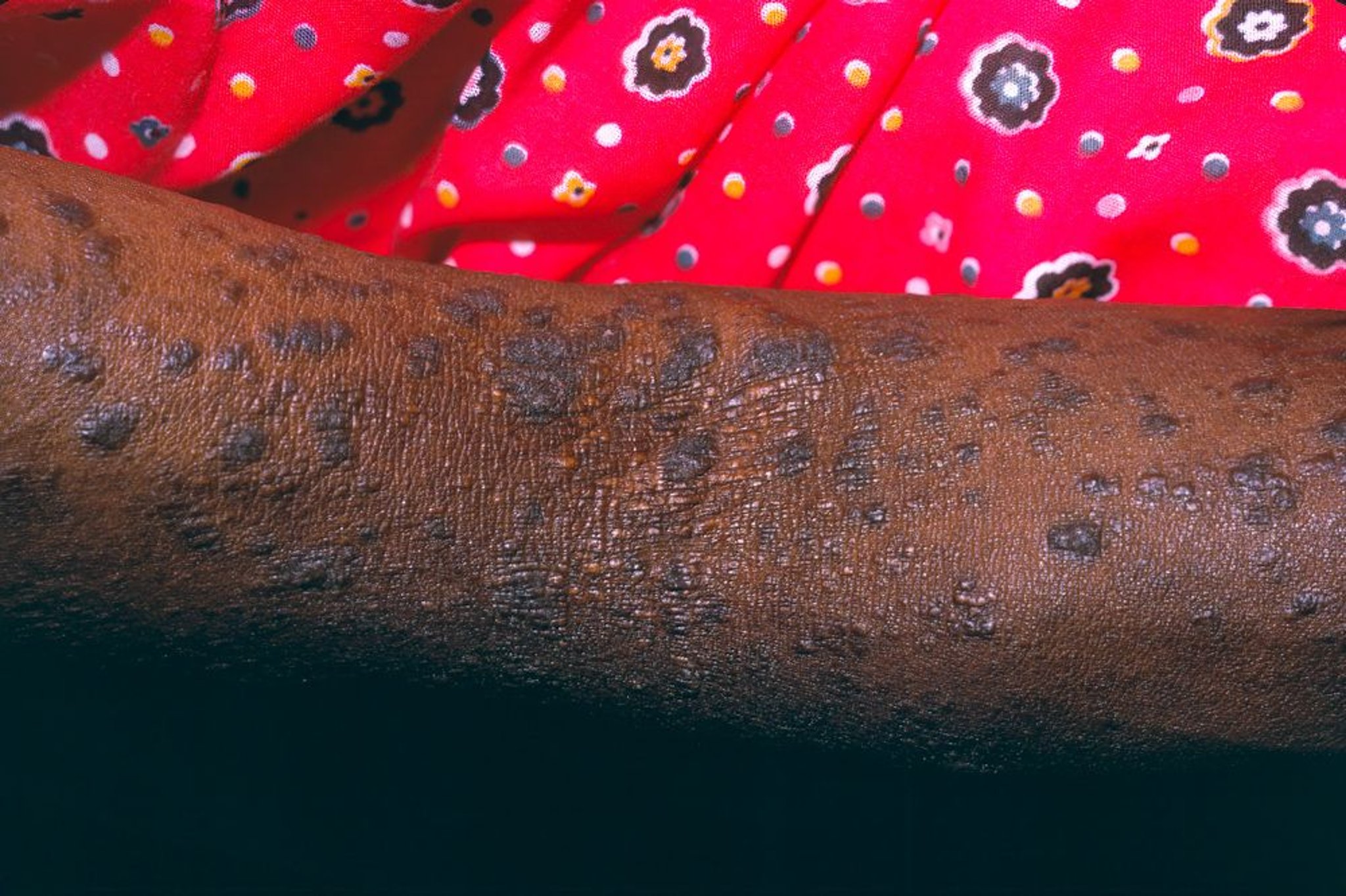 Lichen Planus