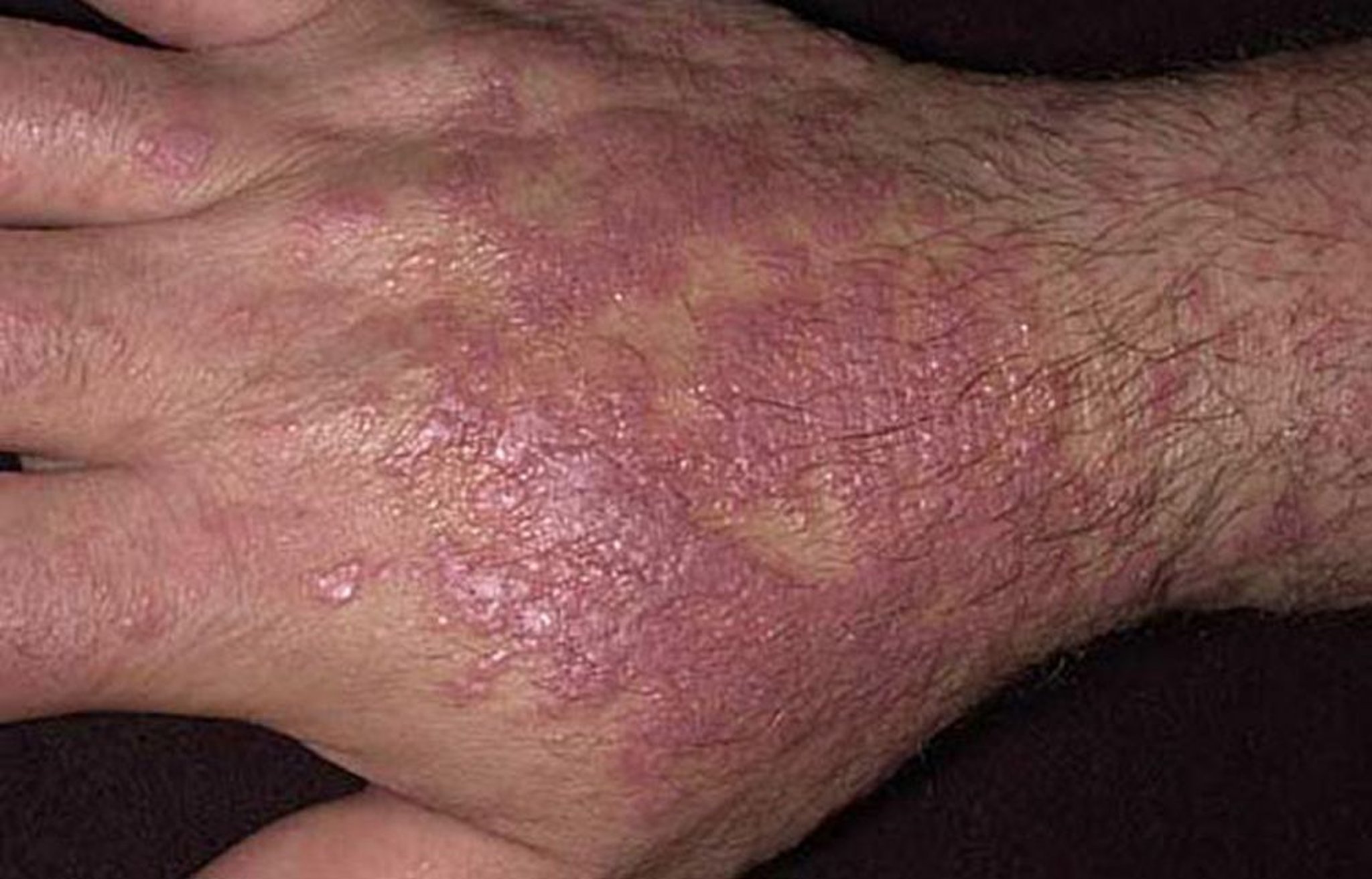 Lichen planus (mano)