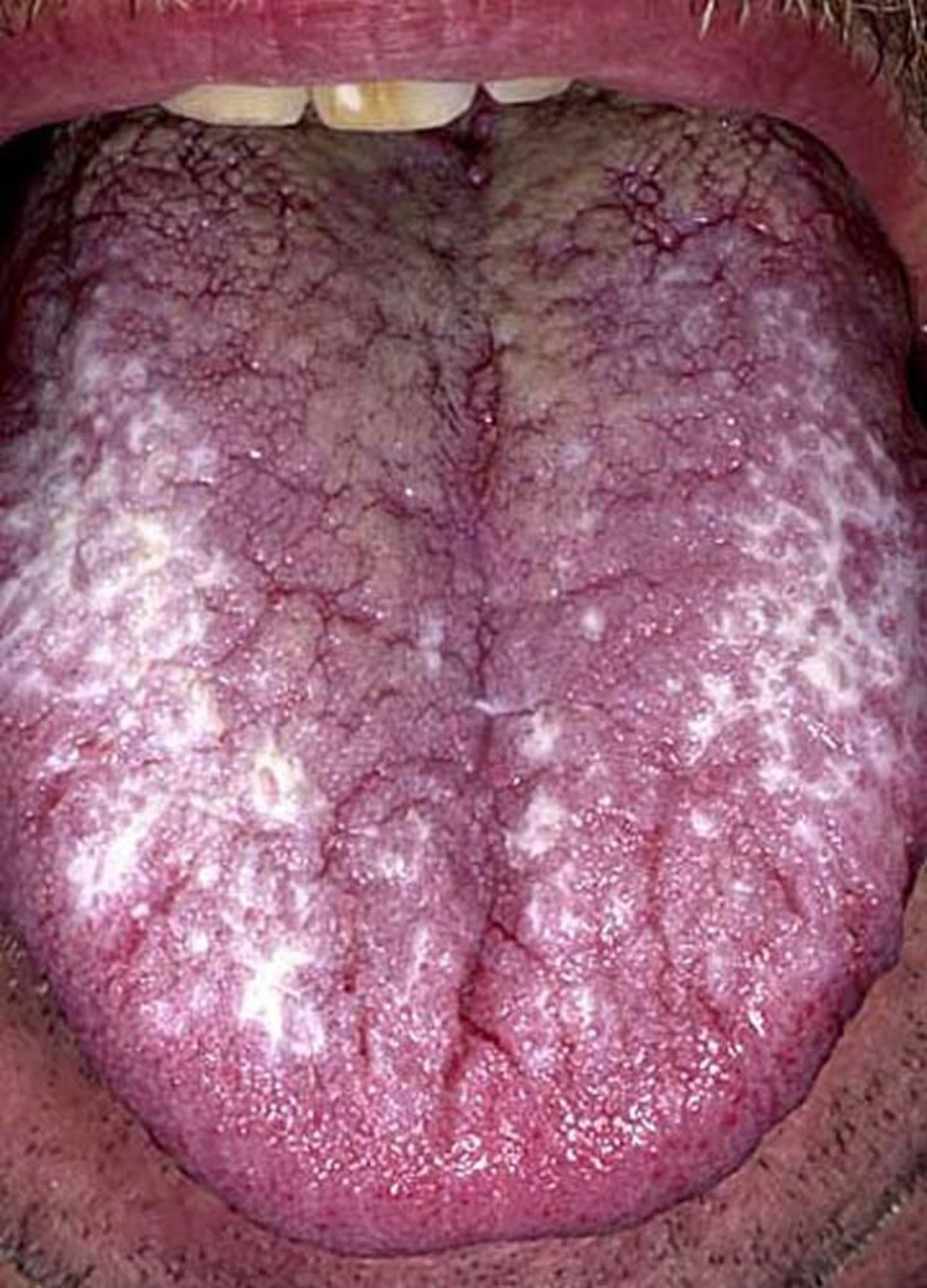 Lichen planus orale