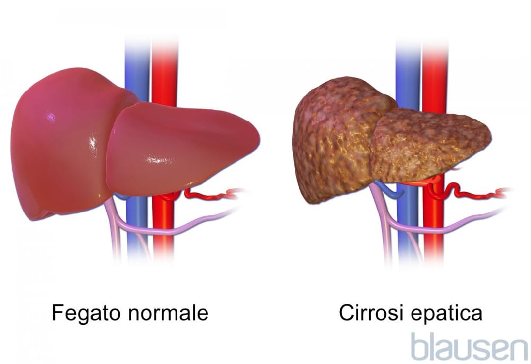 epatopatia-alcol-correlata-patologie-epatiche-e-della-cistifellea