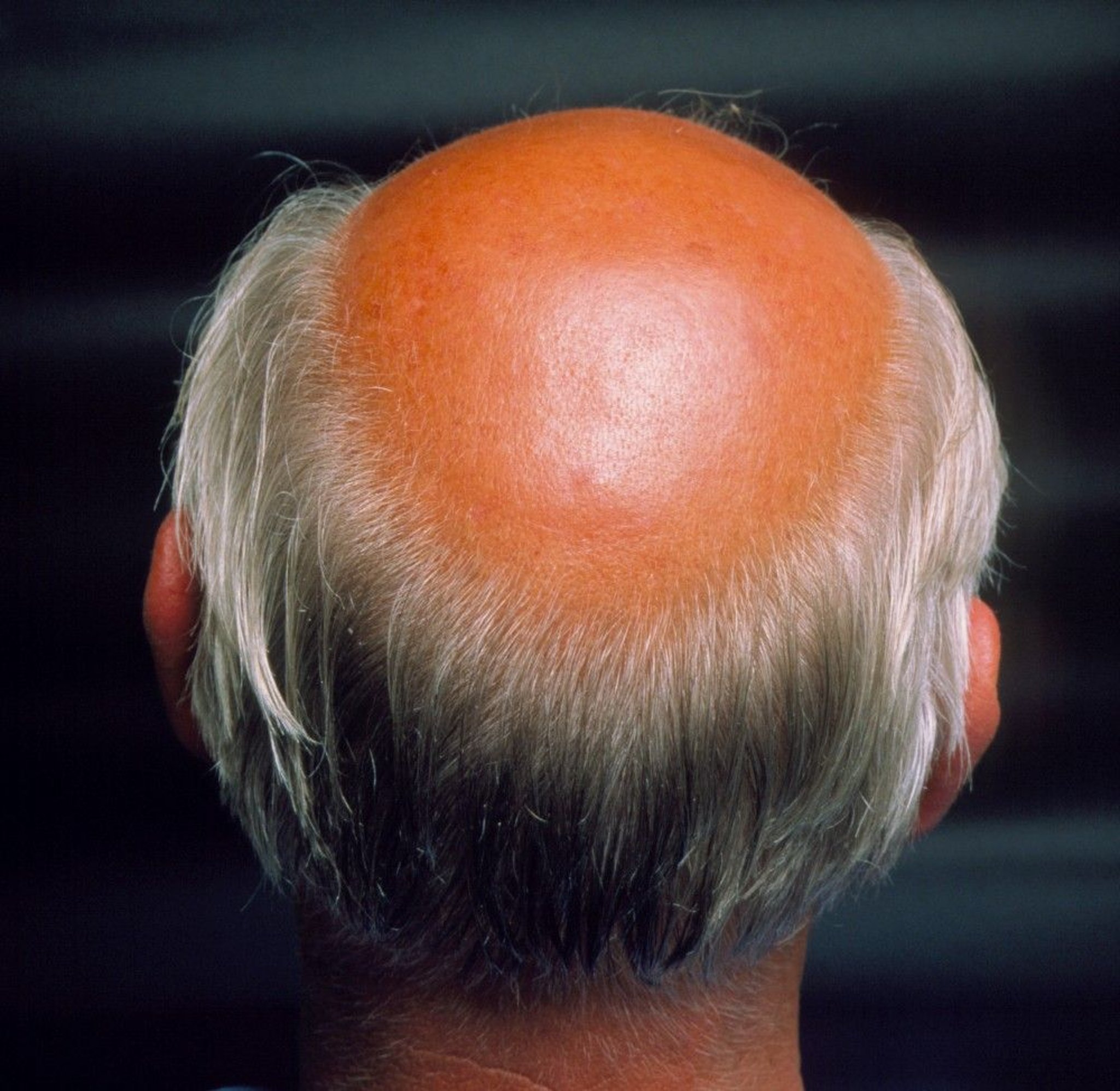 Androgenetic Alopecia