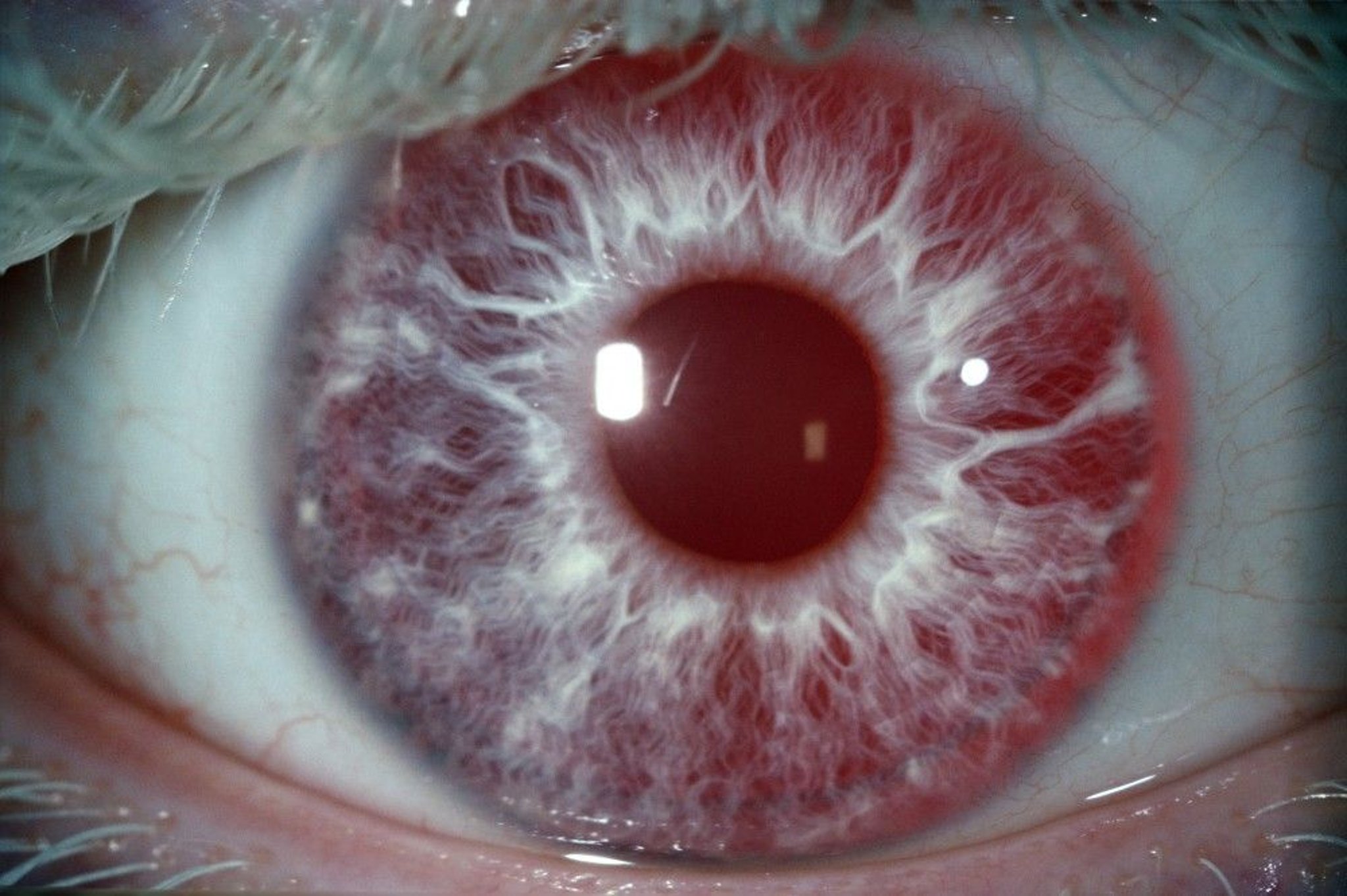 Albinism (Eye Symptoms)