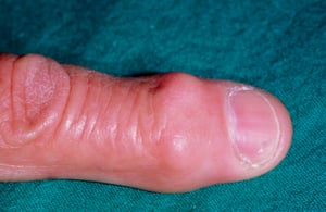 हेबर्डेन नोड्स