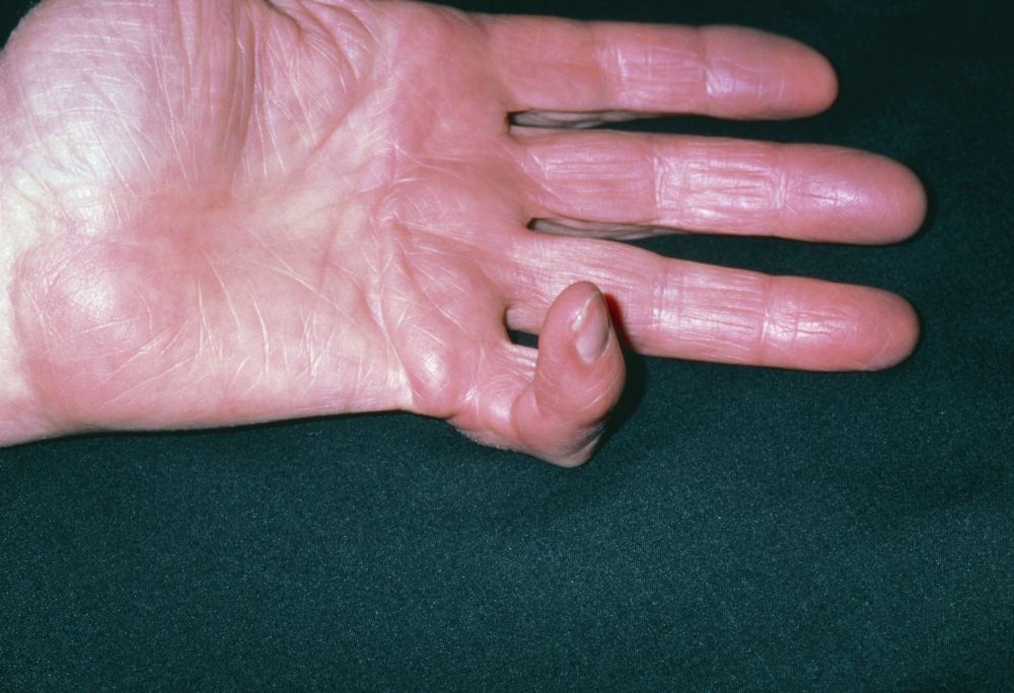 Dupuytren Contracture of the Little Finger