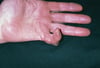 Contractura de Dupuytren del dedo meñique