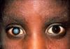 Cataract