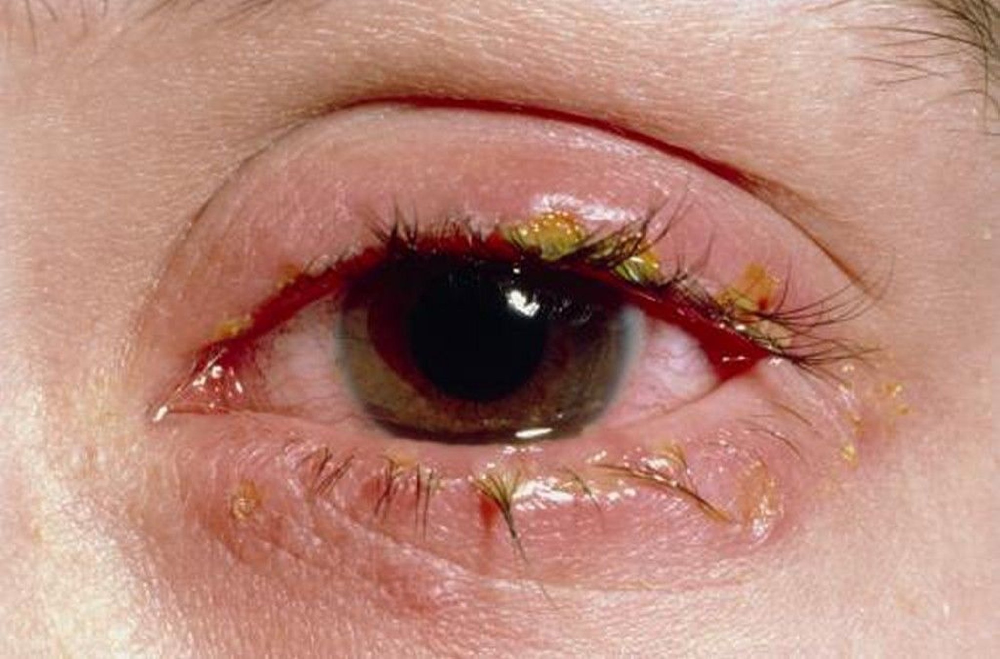 Acute Blepharitis