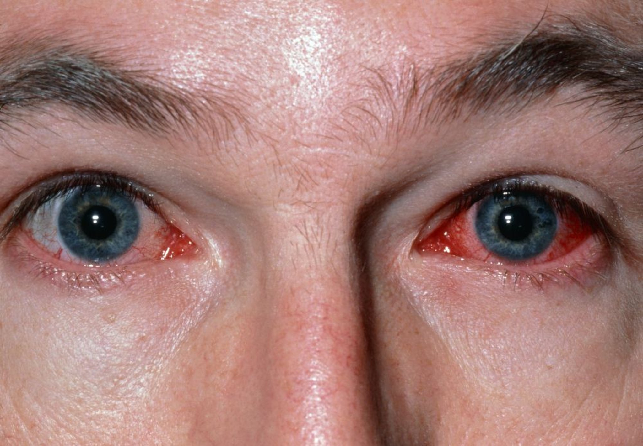 Conjuntivitis infecciosa (viral)