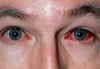Conjonctivite infectieuse (virale)