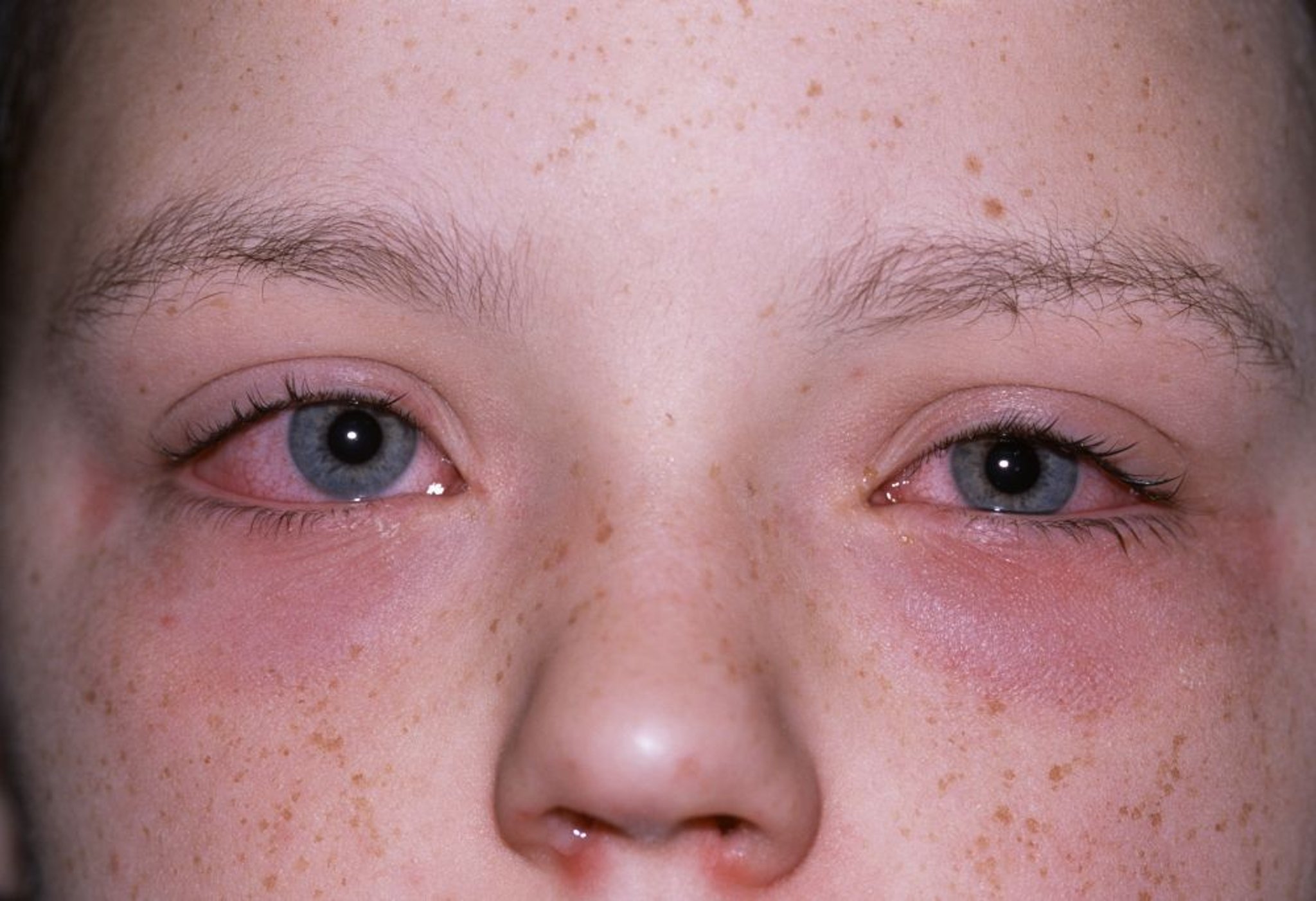 Conjuntivitis alérgica
