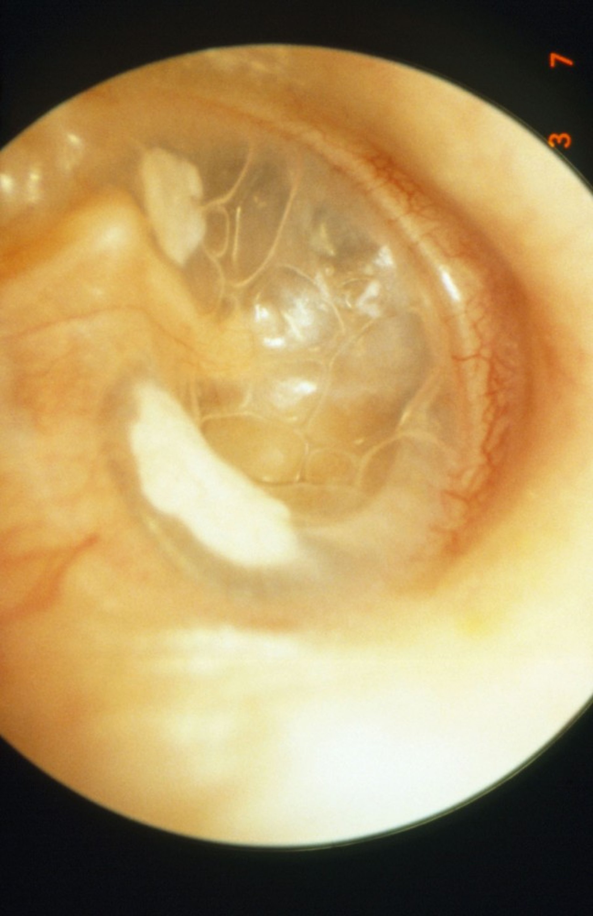 Secretory Otitis Media