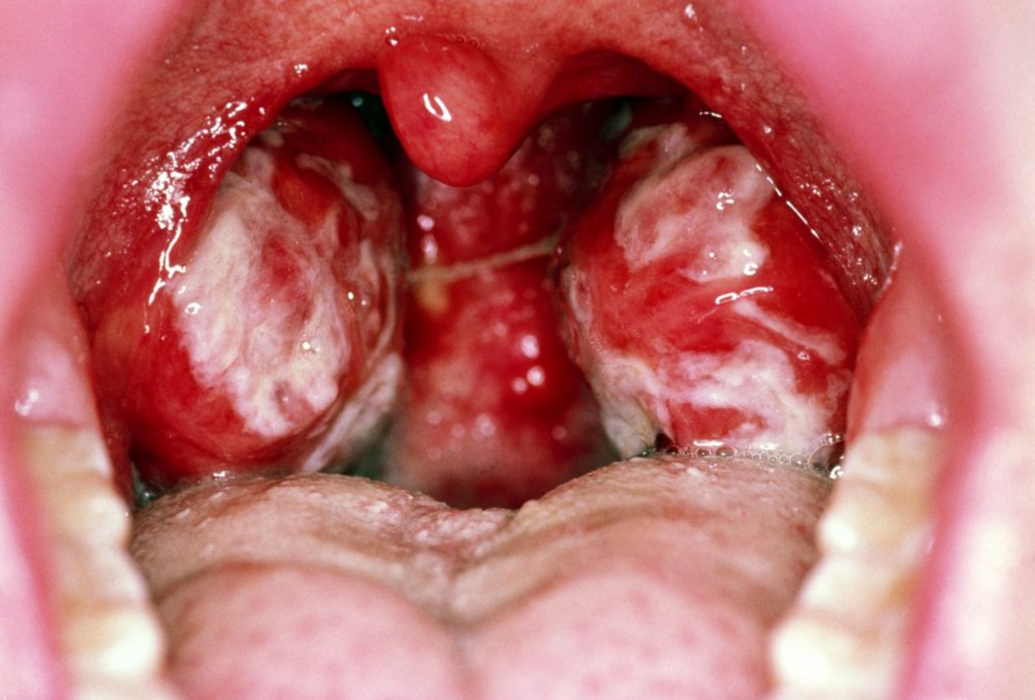 Mononucleose infecciosa que afeta a garganta